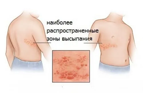 Висип на животі: де шукати причину? як лікувати алергію на животі