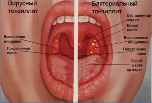 фарингіт скільки лікувати