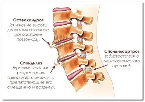 як вилікувати спондильоз шиї