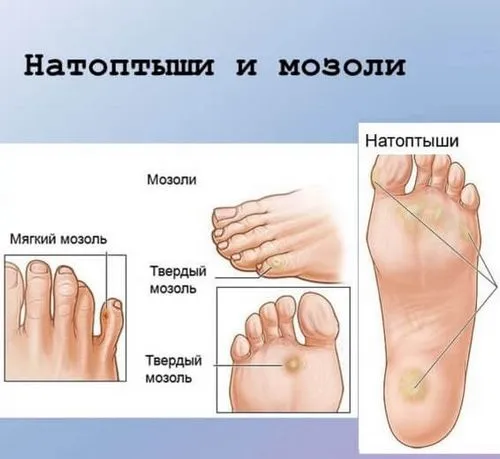сухі мозолі