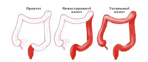 як лікувати товстий кишечник