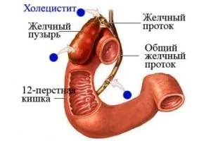 холецистит