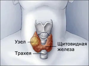 небезпека вузли щитовидна залоза