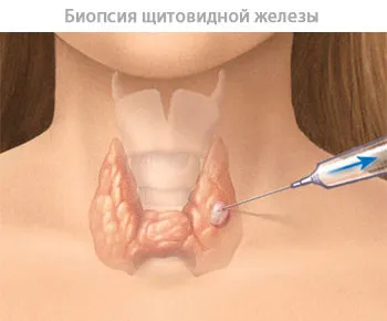 вузловий зоб щитовидної залози