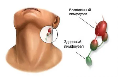 як лікувати хворі лімфовузли