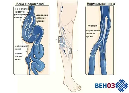 як лікувати варикоз початкова стадія