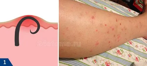 як лікувати прищі після епіляції