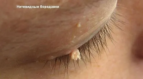 лазером