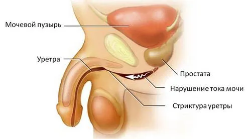лікувати уретрит народними методами
