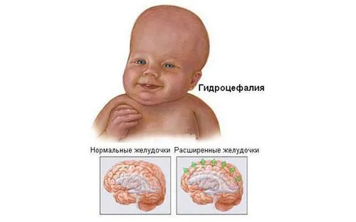 Внутрішньочерепний тиск у дітей - симптоми, причини як лікувати черепну тиск у дитини