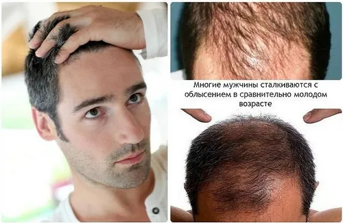 як лікувати випадання волосся у чоловіків