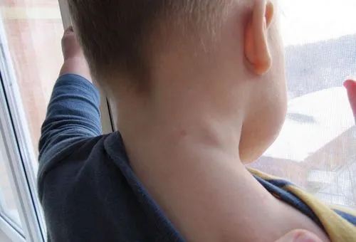 як лікувати лімфовузли під щелепою у дитини