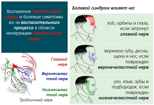 як можна вилікувати невралгію трійчастого нерва