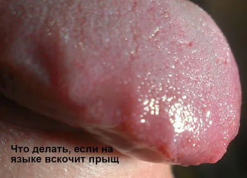 як лікувати прищі на мові в домашніх умовах
