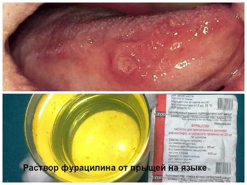 прищ на мові