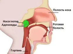 лікувати запалені аденоїди