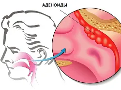 як вилікувати аденоїди без операції у дорослих