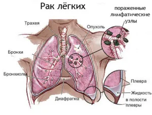 як лікувати пухлина легенів