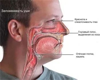як лікувати алергічний риніт в домашніх умовах