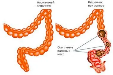 як вилікувати запор раз і назавжди