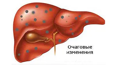 як лікувати жовтяницю