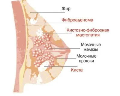 як лікувати железистую мастопатію