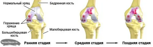 чи можна вилікувати артроз 3 ступеня