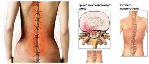 защемлення нерва