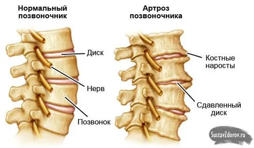 як лікувати артроз хребта