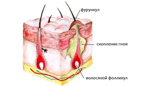 як лікувати золотистий стафілокок і фурункульоз
