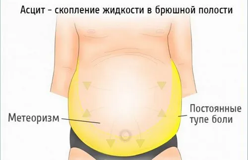 як лікувати цироз печінки і асцит