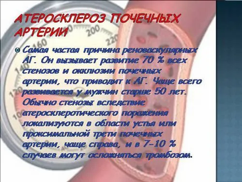 Атеросклероз ниркових артерій (нирок) - причини, симптоми, лікування, діагностика як лікувати судини нирок