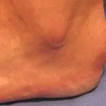 як лікувати бурсит п'яти