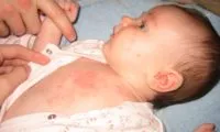 бепантен пітниця новонароджений відгук потничка мазати обличчя мазь допомагає крем
