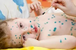 лікувати вітрянку йодом