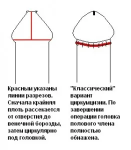 баланопостит діти причини симптоми лікування ускладнення профілактика