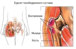 як лікувати хворобу бурсит