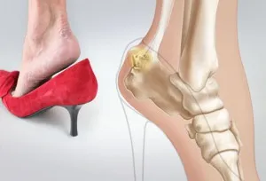 як лікувати бурсит п'яти
