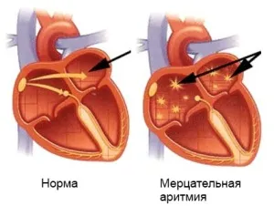 як лікувати миготливу аритмію серця