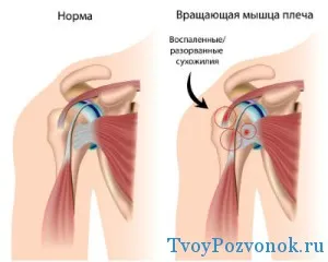 болить плечовий суглоб як лікувати причини лікування правої руки чому болить що робити