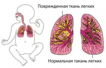 як лікувати атипову пневмонію