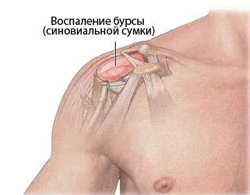 як швидко лікувати бурсит плечового суглоба