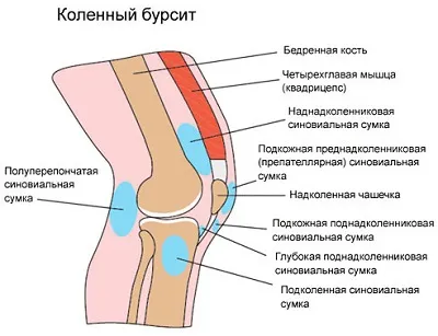 як лікувати колінний бурсит