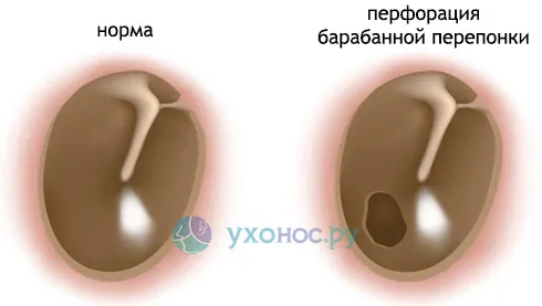 лікувати отит борною кислотою