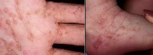 Діагностика корости як лікувати лобковую коросту