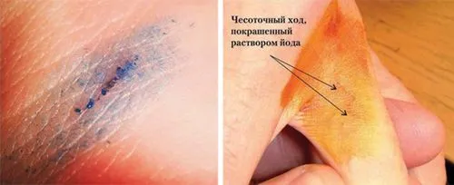 Діагностика корости як лікувати лобковую коросту