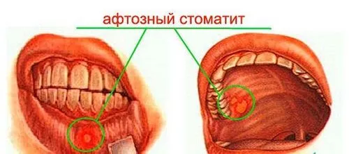 Чим лікувати стоматит як швидко лікувати афтознийстоматит