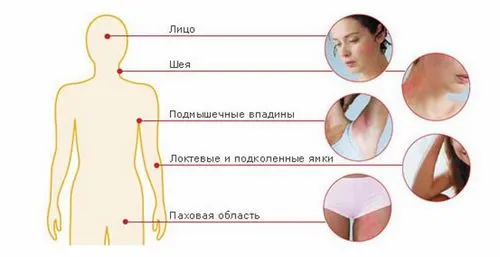 Cеборейний дерматит на обличчі: лікування (симптоми) як лікувати себорейний дерматит особи