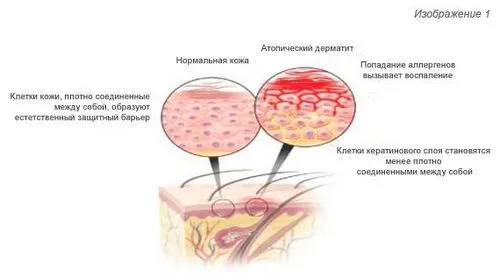 Cеборейний дерматит на обличчі: лікування (симптоми) як лікувати себорейний дерматит особи