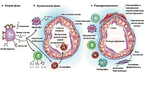 як лікувати алергічну бронхіальну астму